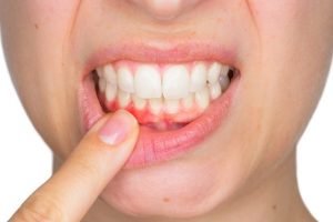 6 Tips Ampuh Hentikan Pendarahan Gusi